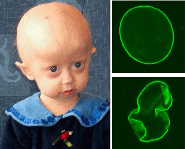 gene editing in progeria