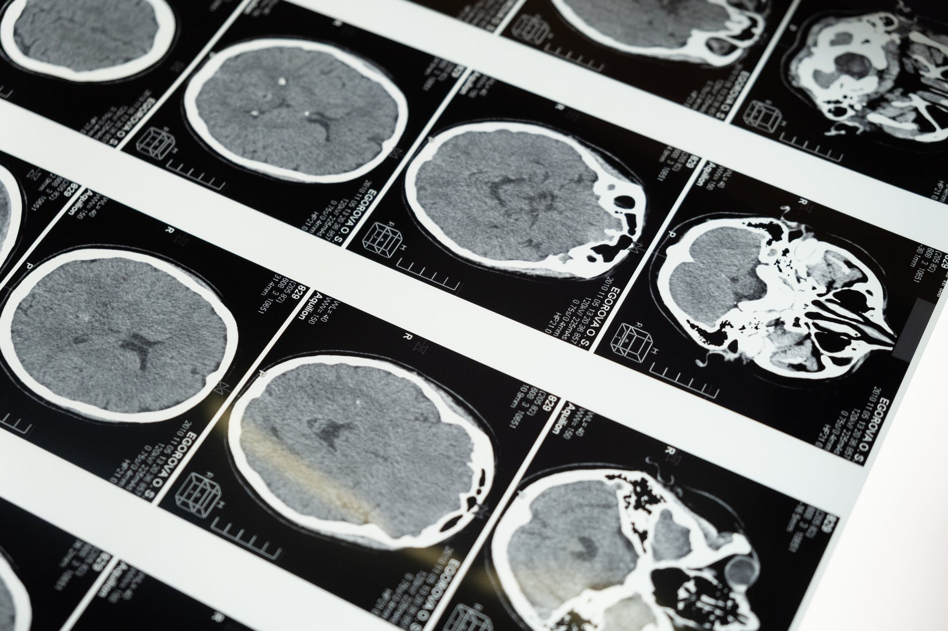 AI can predict Alzheimer's